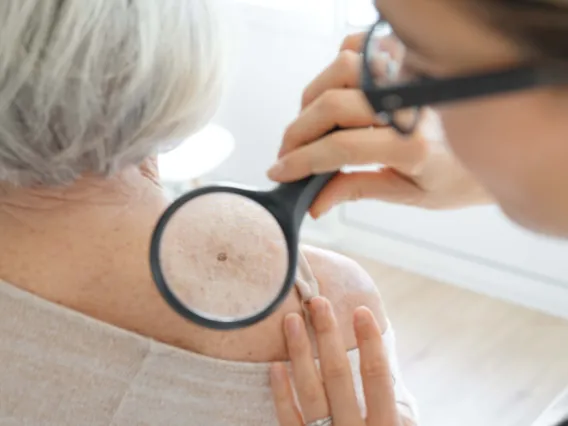 Dermatologist inspect a mole with magnifying glass 