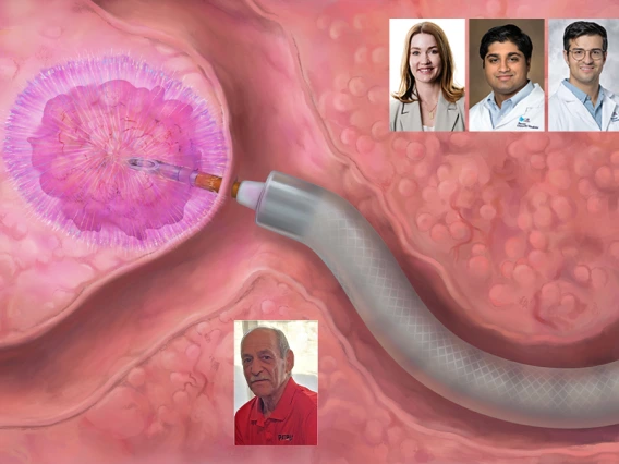 [Image of pulsed electric field therapy to break up cancerous tissue overlayed with portraits of the U of A Interventional Pulmonology physician team and the patient 72-year-old Barry Lebow]